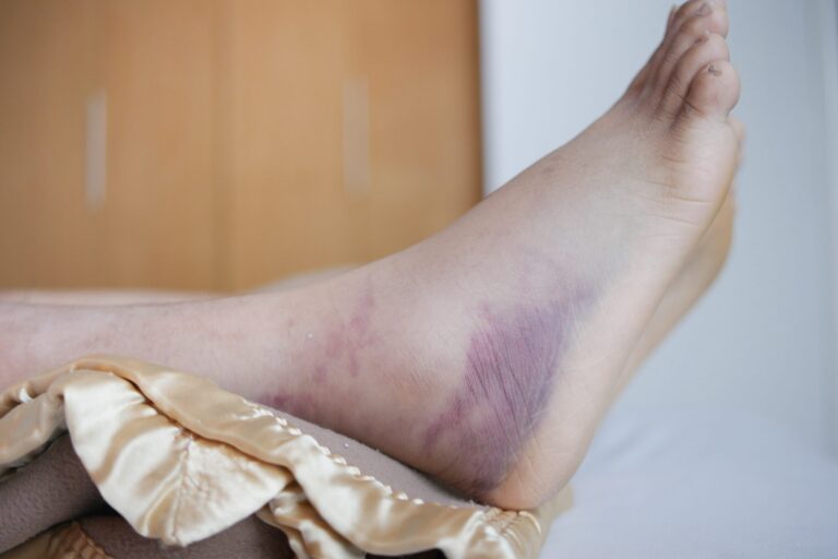 The Beneficial Effects of Electric Cell Signaling (EcST) on Soft-Tissue Injuries 